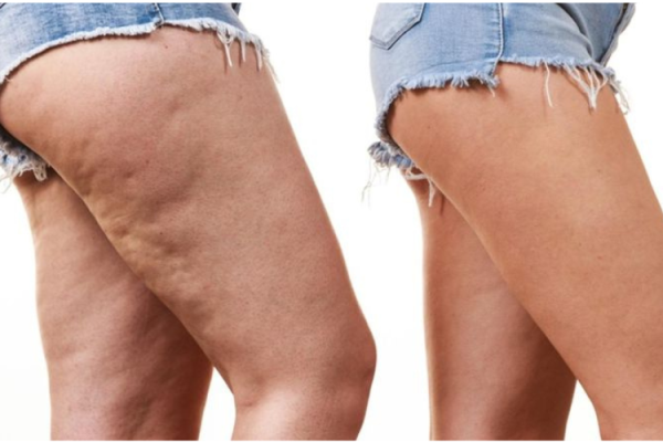 Saddle Bags
Saddle bags refer to the accumulation of fat and cellulite around the hips, buttocks, and outer thighs.
Learn More