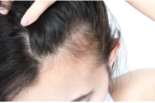 Hair Loss
Mesotherapy and microneedling stimulate regrowth, slow hair loss, and naturally increase hair density.
Learn More