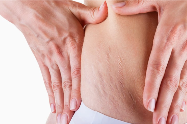 Stretch Marks
Microneedling and nano-fractional treatments help reduce stretch marks, firm the skin, and repair skin damage.
Learn More